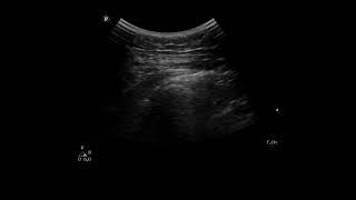 Trochanteric bursa injection