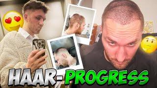 UPDATE ZU MEINER HAARTRANSPLANTATION!  ( Ablauf, Fortschritt & mehr! )