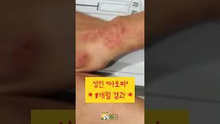몸편한세상아토피관리