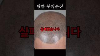 두피문신 부작용 이만큼 위험합니다