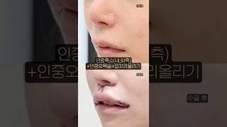 한번에 동안되는 비결?! #인중축소 #인중오목술 #입꼬리올리기