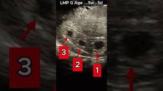 Early Triple Pregnancy - after Ovulation Medications          #ultrasound #pregnant #baby #pcos