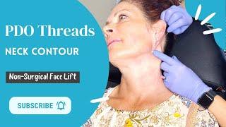 PDO Threads: Neck Lift - Belladerm MedSpa