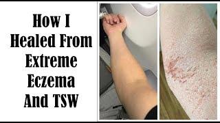 Top 10 Things To Heal From Eczema and TSW - My Journey of Healing