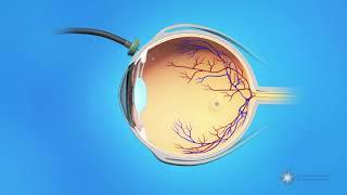 Vitrectomy Surgery for Macular Holes