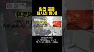 위궤양, 위미란의 실제 모습