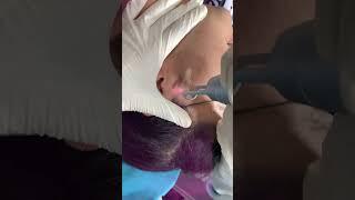 Discover Radiant Skin!  Q-Switch Laser for Skin Whitening & Fine Hair!  | Skinaa Clinic #viral