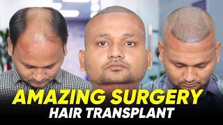 Hair Transplant in Surat | Best Results & Cost of Hair Transplant in Surat