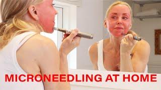 Microneedling DIY at Home - Tips, Warnings and Demo | Over 50