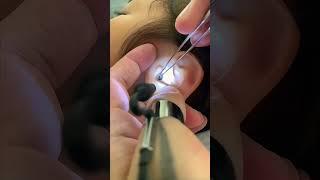 Remove dry earwax that clings to the ear #earwaxremoval #viralvideo #4k #earwaxcleaning #satisfying