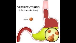 Infectious Gastroenteritis ; Definition, Types, Causes, Symptoms, Diagnosis, Treatment