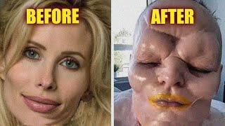 MUST WATCH!! See Celebrities With Biggest Plastic Surgery Disasters!