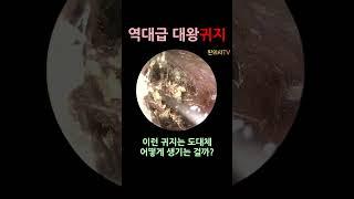 역대급 대왕 귀지제거 영상 #shorts