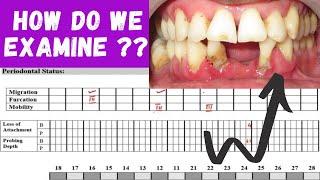 PERIODONTAL EXAMINATION ‖ HOW TO EXAMINE PERIODONTITIS PATIENT ?? ‖ PERIO HUB ‖ Dr  SNEHA