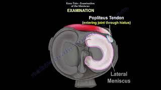 Meniscus tear   and knee pain