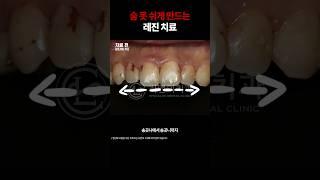충치 치료, 레진으로 어디까지 가능한가. #shorts