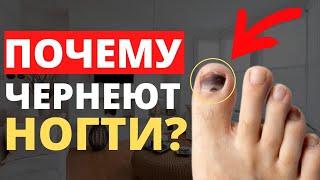 КАК ВЫЛЕЧИТЬ ЧЕРНЫЕ НОГТИ НА НОГАХ? Только 1% Знает, Почему Ногти На Ногах Чернеют!