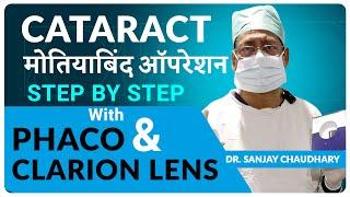 Clareon Lens: Latest IOL by Alcon-USA Revolutionizing Cataract Surgery