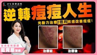 3個月有感改善痘痘！｜青春痘治療｜痘痘治療｜痤瘡治療｜囊腫型痘痘｜動力光治療痘痘｜光動力治療青春痘｜皮膚專科醫師｜EK美學診所｜台中醫美診所