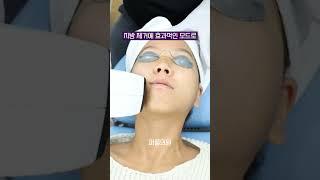 인모드FX 이중턱 심부볼 제거 #인모드