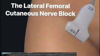 The Ultrasound Guided Lateral Femoral Cutaneous Nerve Block