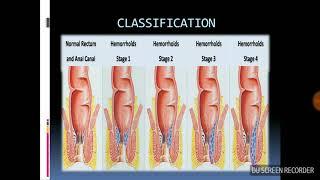 Haemorrhoids (HINDI)