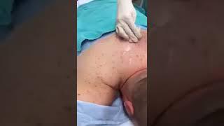 Doctor Cool   INFECTED CYST BEING LANCED