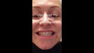 Jessica - Q&A about my instasmile clip on veneers