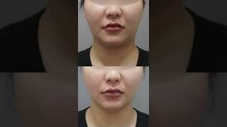[닥터쁘띠] 지긋지긋한 이중턱 이제 안녕! 잘 지내지 말고 다시 보지 말자! 이중턱 실리프팅 전후사진 방출!!! #피부과 #닥터쁘띠 #피부관리 #이중턱리프팅 #이중턱 #실리프팅