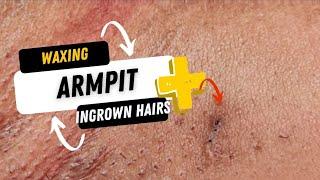 UNDERARM WAXING & BLACKHEAD