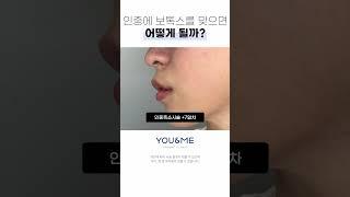 얇은 입술 긴 인중을 개선하는 방법! #인중보톡스 #입술필러