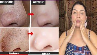 सिर्फ 3 USES में खत्म करे Blackheads, Whiteheads,Clogged Pores  को | How to remove Blackheads|