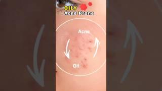 The Simple Solution For Oily Acne-Prone Skin #Shorts #Trending #AswinC #Short #Beautytips #Viral