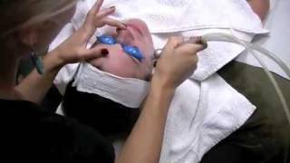 Microdermabrasion STL