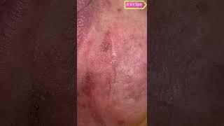 AlinSpa(70)_Acnes Mụn Ẩn Quanh Miệng