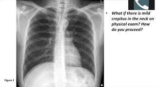 Thoracic Surgery Didactics—Esophageal Perforation