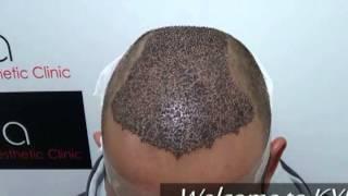 Best Hair Transplant Center in Ludhiana, Punjab - Kyra Clinic