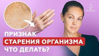 Возрастная пигментация | Опасный симптом или косметический эффект?