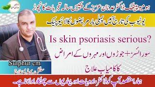 Psoriasis And backpain Treatment l live patient checkup l Dr Adnan Aziz Mehria11