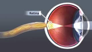 Animation: Cataract