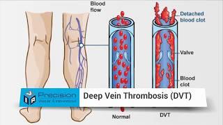 DVT a Solution for Blood Clots - Deep Vein Thrombosis