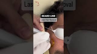 Beard Line Laser Hair Removal
