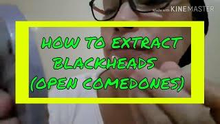 How To Extract Blackheads ( Open Comedones)|Doc Avonasac