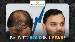 From Bald to Bold in 1 Year | Hair Transplant Before and After Results