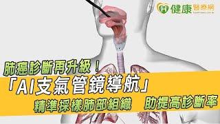 肺癌診斷再升級！「AI支氣管鏡導航」精準採樣肺部組織　助提高診斷率｜健康醫療網