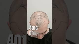 Hair Transplantation Process at Dr. Ulusan Clinic 