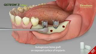 Dentium Osteon 3 Collagen