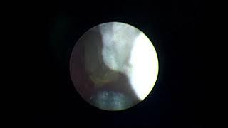 Percutaneous Nephrolithotomy Short Clip