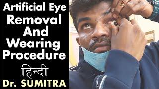 How To : ARTIFICIAL EYE removal and wearing procedure - Hindi | Dr Sumitra