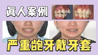 真人案例 | 18岁女生严重龅牙 拔牙固定矫治 两年左右